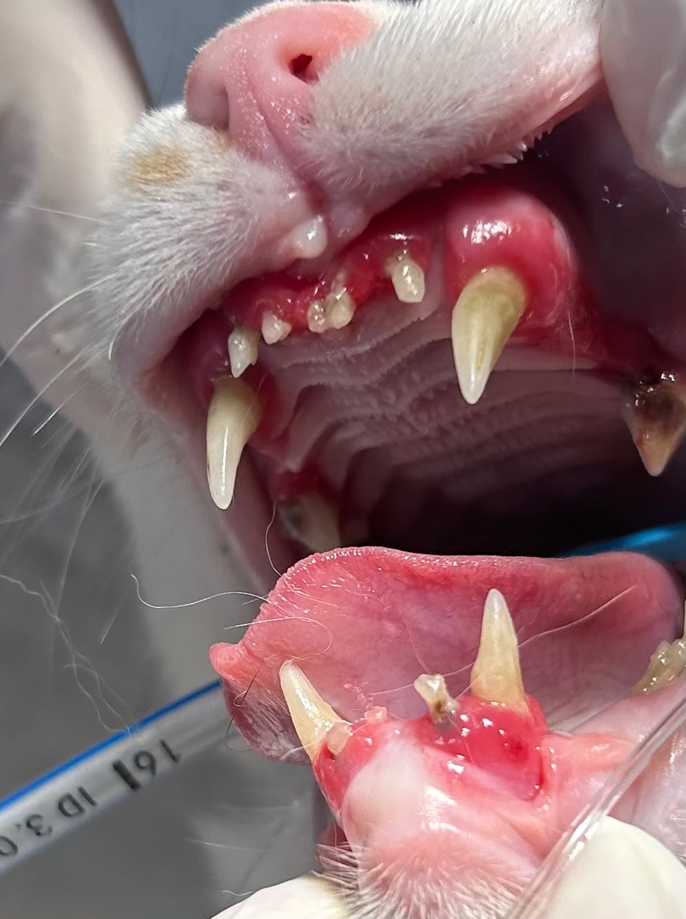 Encías severamente inflamadas y cálculo dental en Katty antes del procedimiento